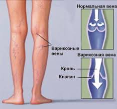 Boli V Nogah Set Klinik Osteomed