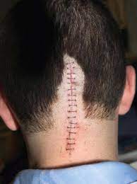 Brain tumor side effects depend upon many factors, and may not be the same for each person. Adjusting To Life After Surviving A Brain Tumor
