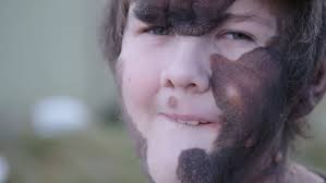Rare giant mole covers boy's whole body and part of his brain