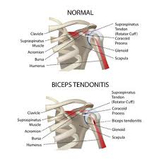 Shoulder stretches are great for shoulder tendonitis which is basically an inflammation to the tendons in your shoulder. 946 Best Bicep Tendon Images Stock Photos Vectors Adobe Stock