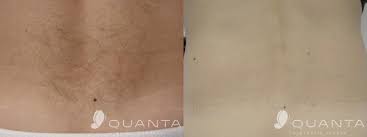 And remember to follow this advice after. Laser Hair Removal Lafayette Co Arejuvenation Skin Care