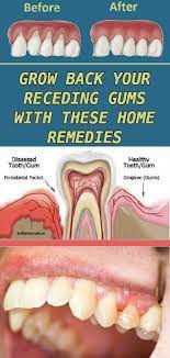 Make Your Smile Is As Beautiful As Ever With These Natural Tips Teeth Health Receding Gums Health And Nutrition