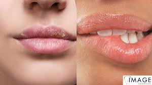 Image result for Lip Cancer