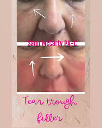 In this patient, Sami McCarty PA-C...