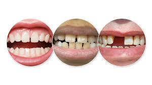 There are not a lot of options available when looking at how to reduce gap between teeth naturally. Gap In Teeth