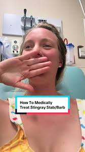 Navigating Stingray Stings: My Painful Experience