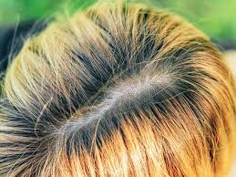 Overlapping Bleach On Hair - Sozo Hair, Spa & Wigs