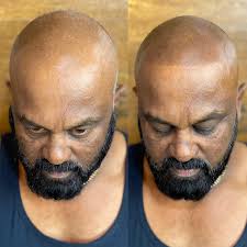 Lunar Scalp Micro Pigmentation