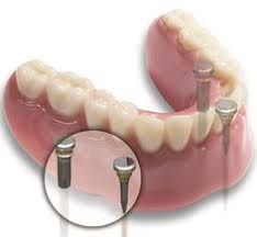 43 Bone Grafting Ideas Bone Grafting Grafting Dental