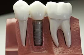 How Many Teeth Can You Put On One Implant?