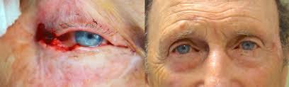 In the united states, it's estimated that doctors diagnose over 100,000 new skin cancer cases each year. Eyelid Skin Cancer Archives Jeffrey M Joseph