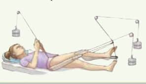 Traction by sarah gobbell ppt video online download. Chapter 23 Traction Examples Flashcards Quizlet