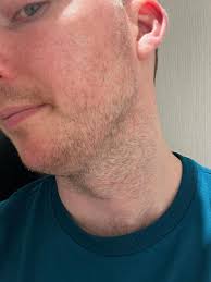 Image result for Beard Dermatitis