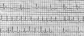 Diagnosis And Treatment Of Sick Sinus Syndrome American Family Physician