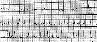 Tachycardia is classified as stable or unstable. Diagnosis And Treatment Of Sick Sinus Syndrome American Family Physician
