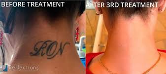 Reflections center is ranked #1 medical spa in livingston & martinsville, nj for home. Best Tattoo Removal Treatments Near Me Nj Laser Tattoo Removal Cost