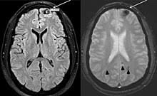 Poland Syndrome Wikipedia
