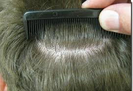 They won't care that you have something holding your hair b/c they'll cover your hair with a hairnet before you go into the or anyway. Hair Restoration Surgery Challenges And Solutions Ccid
