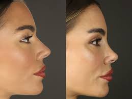 Rhinoplasty Near Me in Temecula, Murrieta & Menifee | Nose Job Surgery