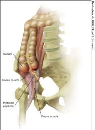 Image result for Psoas Sign
