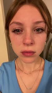 I got toothpaste in my eye..