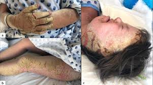 Image result for scabies norvegica