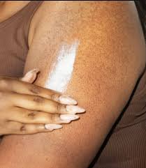 Image result for Keratosis pilaris
