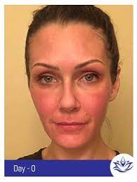 Call now or request an appointment online. Before And After Gallery Pacific Coast Aesthetics In Aptos Ca