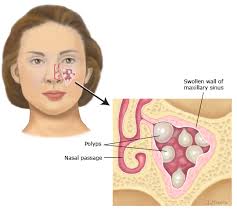 Here are some nasal polyps photos that will. Patient Education Chronic Rhinosinusitis Beyond The Basics Uptodate