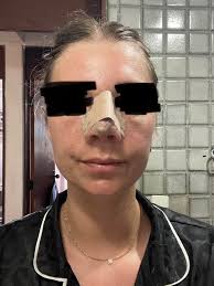 Just had surgery yesterday. I like the profile photo the Dr took right  after surgery but looking from the front today I just look like miss piggy  😭 I can see the