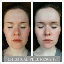Pin On Facial Peel