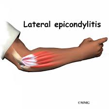 Always consult a doctor before attempting exercises for tennis elbow. Tennis Elbow Eorthopod Com