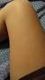 Treatment Keratosis Pilaris