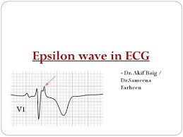 Image result for Epsilon Wave
