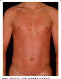 There are no specific treatments available in the industry that could treat the condition. Amoxicillin Rash In Patients With Infectious Mononucleosis Evidence Of True Drug Sensitization Semantic Scholar
