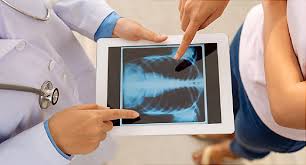 The tumor is usually smaller than 2 stage iv stage iv lung cancer has spread outside the lung and lymph nodes, occasionally causing pleural effusions — a collection of fluid around the. What Does Your Lung Cancer Stage Mean