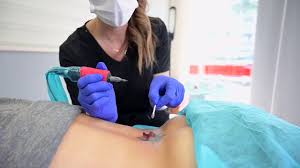 Laser tattoo removal at your clinic or salon is a great addition to the list of treatments you provide, and at mata courses our laser tattoo removal training course is second to none. Undo Non Laser Tattoo Removal Youtube
