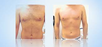 D'année en année, l'épilation laser pour homme se développe. Epilation Laser Homme Paris Dr Netter Dermatologue A Paris