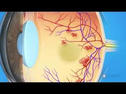 You should plan to make regular eye doctor visits when you have diabetes.high blood sugar can lead to problems like blurry vision, cataracts, glaucoma, and retinopathy.in fact, diabetes is. What Is Diabetic Retinopathy American Academy Of Ophthalmology