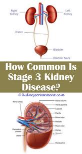 Kidney Health Doctors Kidney Disease Diet Kidney Disease Polycystic Kidney Disease