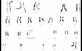 See full list on healthline.com A Case With A Balanced Heterologous Robertsonian Translocation Download Scientific Diagram