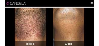 Skin house also provides the soprano, which is a diode laser. Gentlemax Pro Laser Hair Removal My Haven Laser Spa Facebook