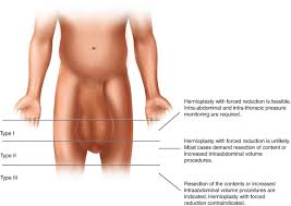 Image result for Inguinal hernia man