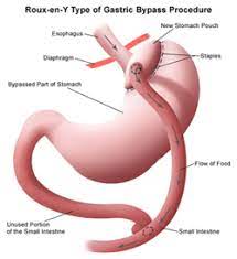 Learn how much a gastric sleeve (inpatient) costs in texas. Gastric Bypass Surgery North Tx Gastric Surgeons