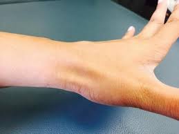 Scaphoid Fracture And Avascular Necrosis Springerlink Inflammation of the 1st extensor 3. scaphoid fracture and avascular