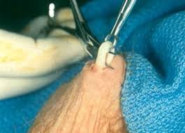 Vasectomia En Malaga Tratamiento Urologico