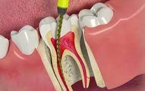 Our powerful toothpaste collection helps reverse early gum damage. A Step By Step Guide To Root Canal Treatment