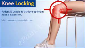 A locked knee is where the knee cannot properly either bend or straighten. Knee Locking What Causes Locked Knee And How Is It Treated