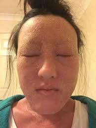 Topical corticosteroid side effects