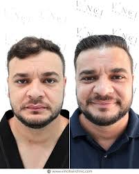 VINCI HAIR CLINIC USA